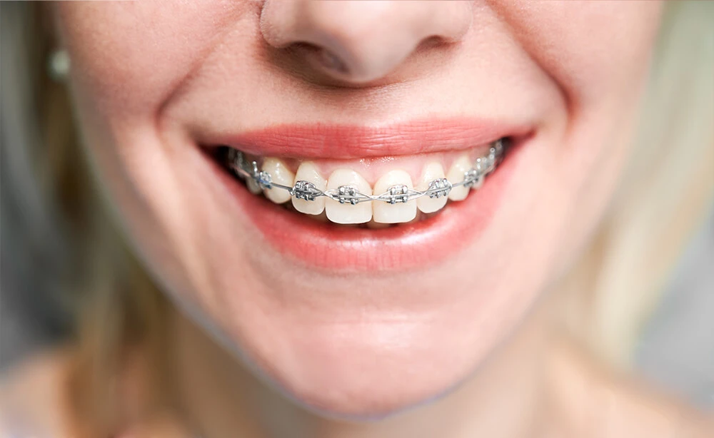 Sorriso com aparelho fixo