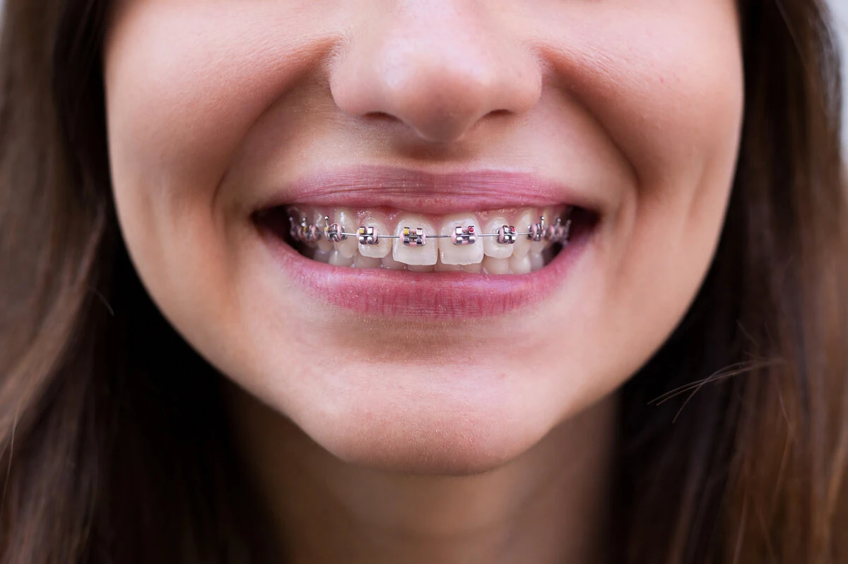 Sorriso com aparelho fixo